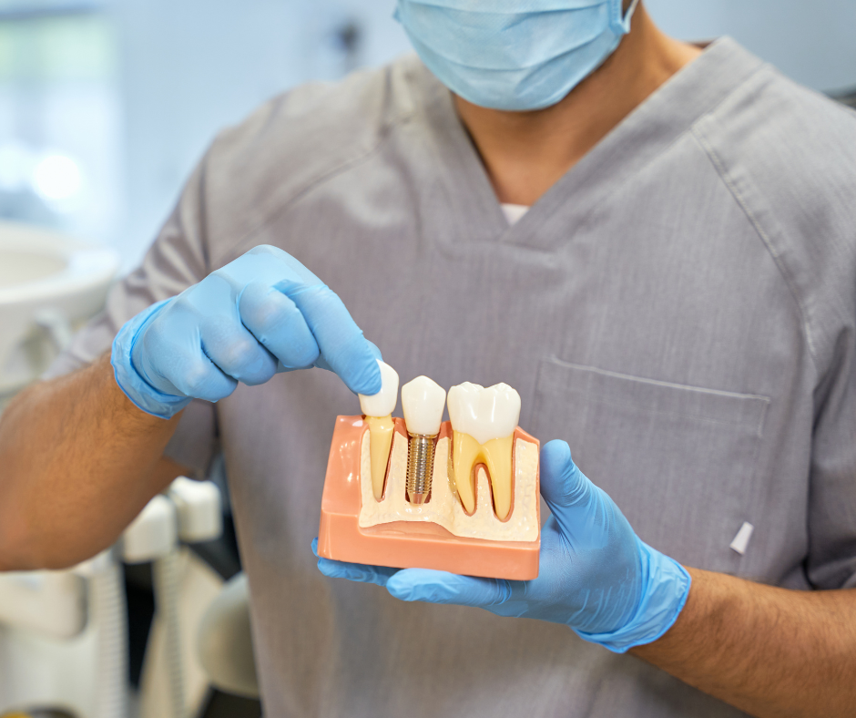 Implantes Dentários